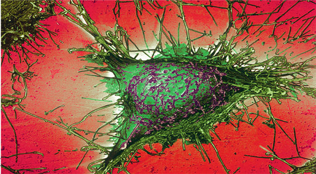 Clinical Updates: ziekte van Alzheimer